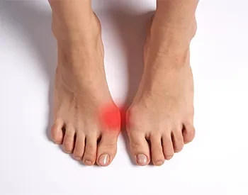 Причины появления косточки на ногах
