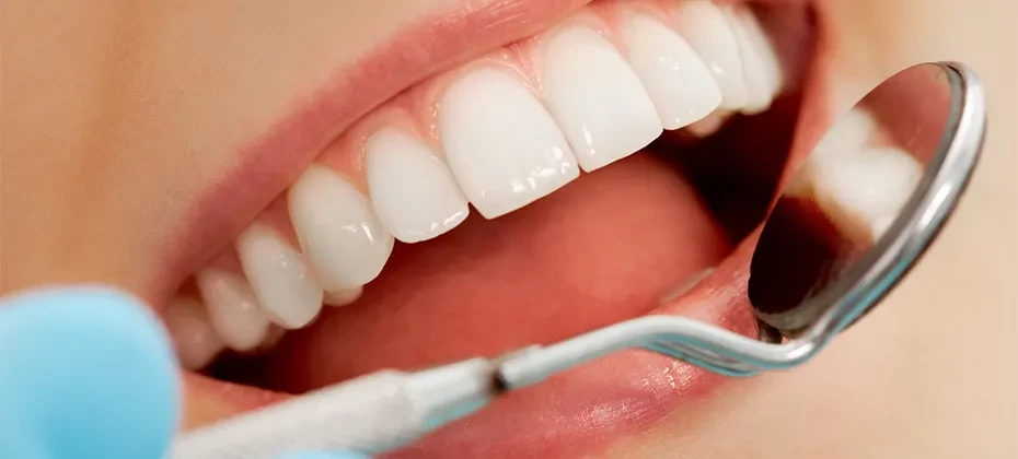 Зубний камінь: причини та способи видалення